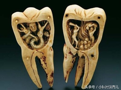 儿童乳牙龋齿烂了有必要补牙吗,乳牙蛀了是套牙套还是补牙