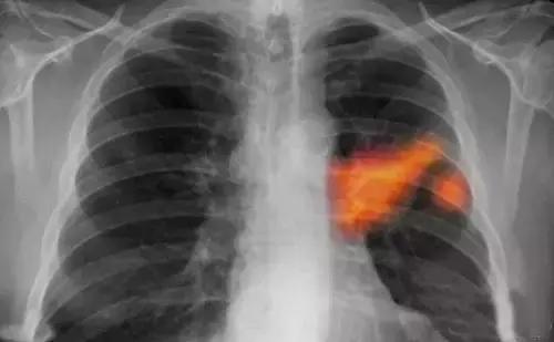 肺癌患者有手麻的症状吗,肺癌患者经常胳膊麻木怎么回事