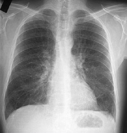 支气管扩张最有诊断价值的检查是,什么是支气管扩张和哮喘