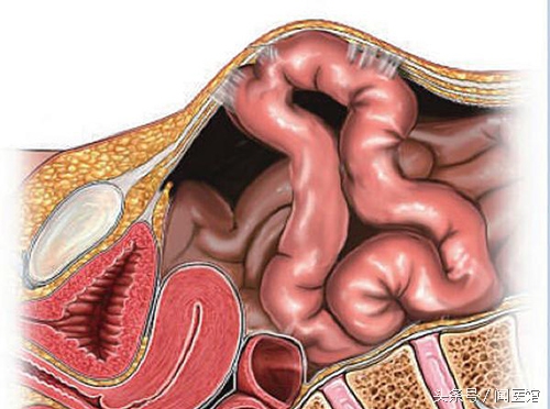妇科腹腔手术后怎么护理,剖宫产腹腔粘连要手术吗
