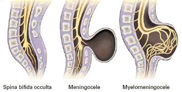 隐性脊柱裂引起尿床中医治疗方法,儿童骶1椎体隐性脊柱裂怎么治疗