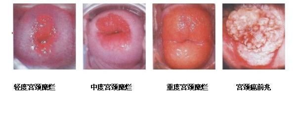 医生说点大实话:这些妇科病真不用手术