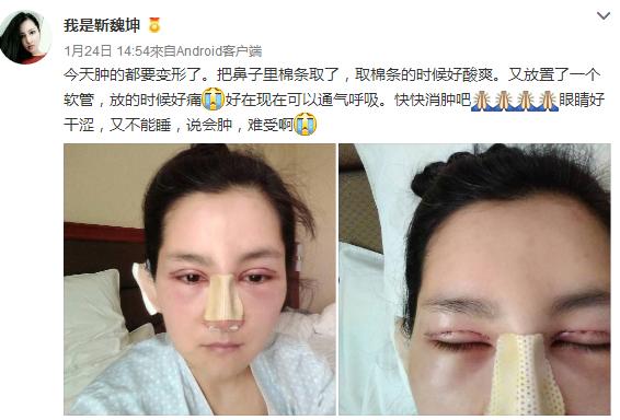 整形越早越好还是越晚越好,整形反而把自己越整越丑怎么办