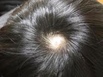 22岁小伙因斑秃或失女友,15年专家临床经验倾囊相授辩证施治