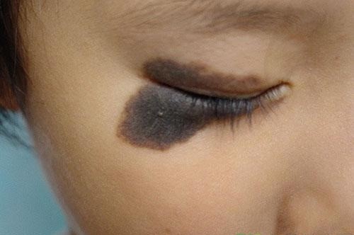 孙红雷谈黑痣长在哪里,孙红雷演的黑痣病变