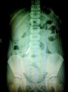 磁铁吞到小孩肚子里会怎么样,小孩吞磁铁到肚子里面