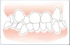 一吃东西就塞牙有什么好办法,怎样防止食物塞牙