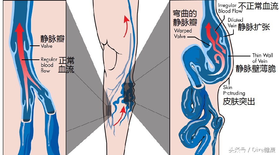 坐得久了小腿肿怎么办,静脉曲张引起的小腿肿怎么消除
