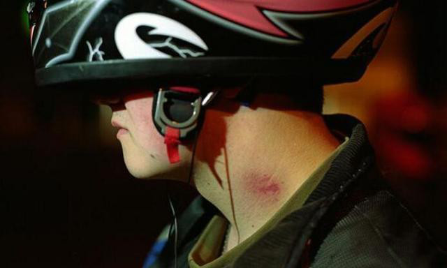 夺命一吻,男孩被女友留吻痕丧命