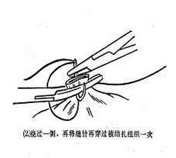 女性结扎以后复通手术全过程,女性结扎的手术步骤