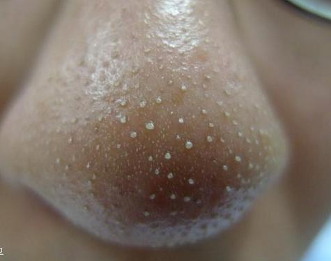 清除鼻头粉刺的正确有效方法,鼻头粉刺正确处理方法