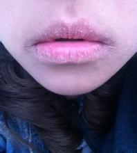 嘴唇干裂，越干越想舔，越舔越干躁结痂，这是咋哩？