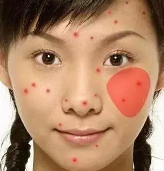 各个地方长痘的原因以及解决方法,长痘到底是什么病啊