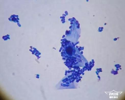 头痒掉头皮屑出油秃了一块,孕期头发出油痒头皮屑多怎么办