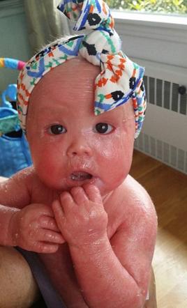 婴幼儿脖子花斑癣多久可以痊愈,婴儿花斑癣怎样算治好了