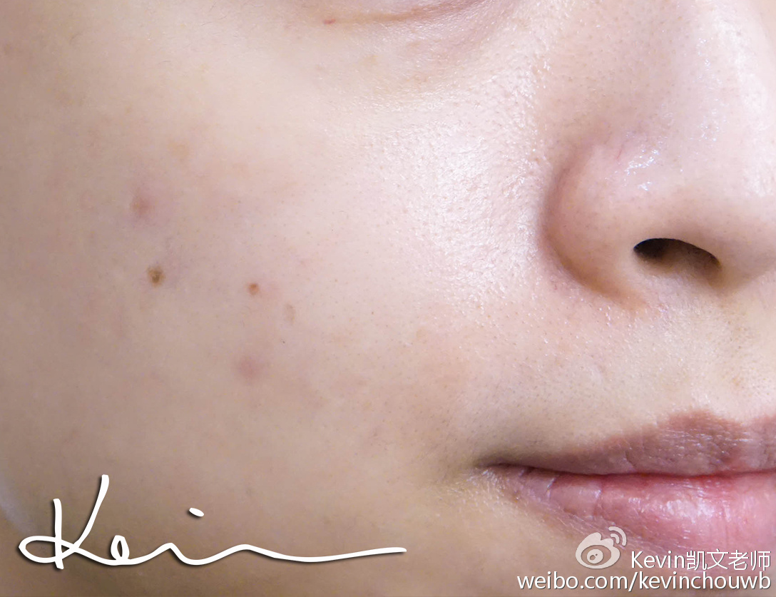 美妆去粉刺最有效的产品,痘痘粉刺黑头用什么化妆品