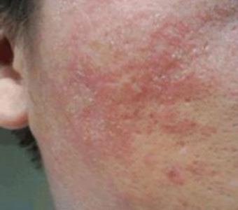 什么是激素过敏性皮炎,激素过敏性皮炎脸部图片
