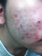 宝宝脸上痘痘有白色脓包,脸上长脓包痘痘留疤