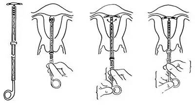 安了环怀孕了能要吗,安环还会怀孕吗