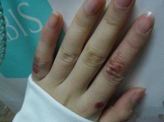 冻疮又痛又痒简单一头蒜就可解决