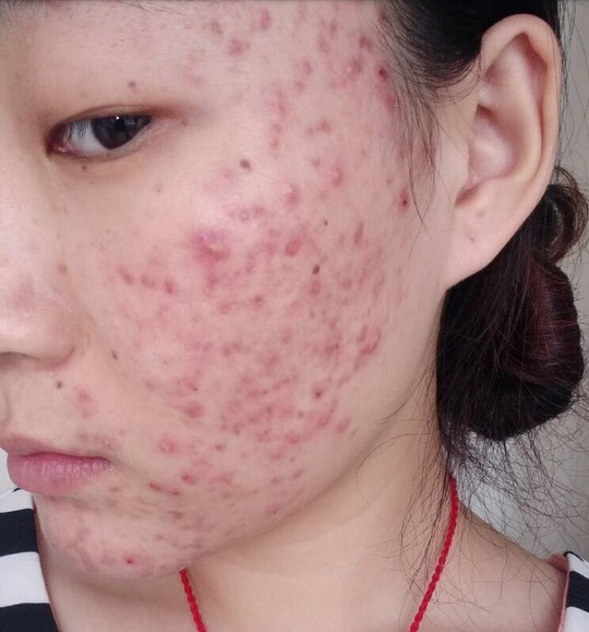 痘痘反反复复长的原因和应对方法,发际线两边痘痘反反复复一直冒痘