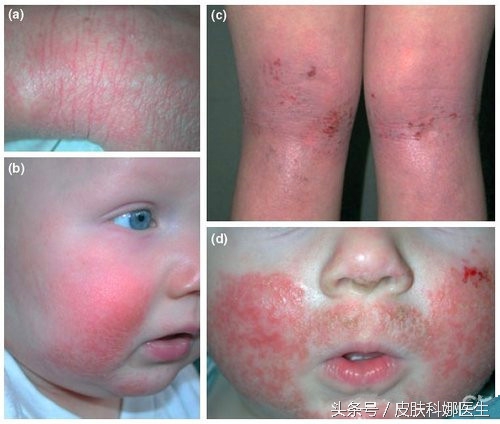 孩子反复湿疹皮炎怎么回事,儿童湿疹久治不愈变成特异性皮炎
