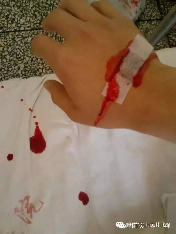 如何扎针不痛,怎么扎针才能不疼