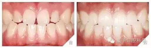 牙中间有缝怎么办,前牙有缝修复
