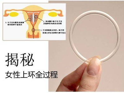 顺产还在出血可以上环吗,生孩子大出血后可以上环吗