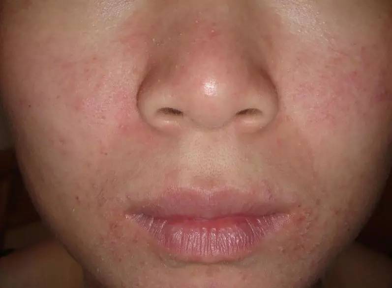 得了脂溢性皮炎会不会加重焦虑,得了脂溢性皮炎会有皱纹