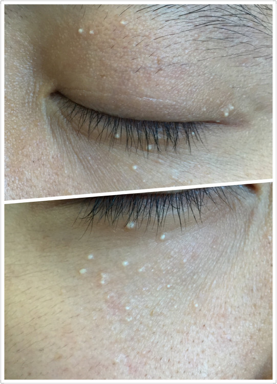 眼睛周围有白色的小点是不是疣,眼睛下边有白点不是脂肪粒是什么