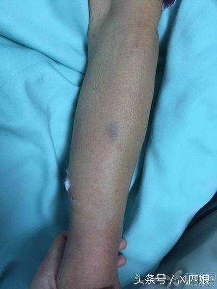 动脉抽血后淤青怎么办,股动脉抽血后出现皮下血肿怎么办