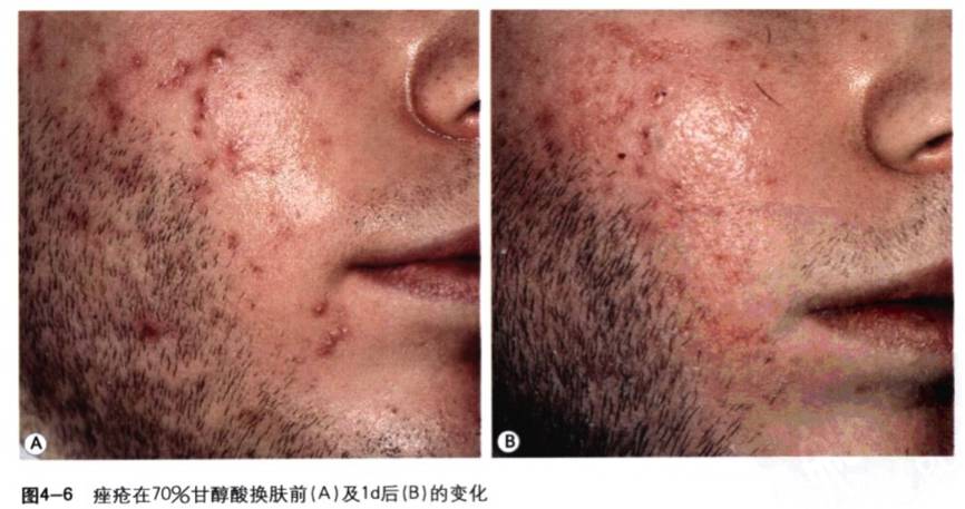 果酸换肤方法,果酸换肤让皮肤焕然一新