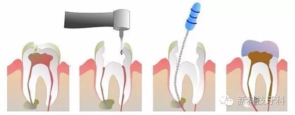 开牙科诊所需要注意事项,牙科机扩的步骤流程及注意事项
