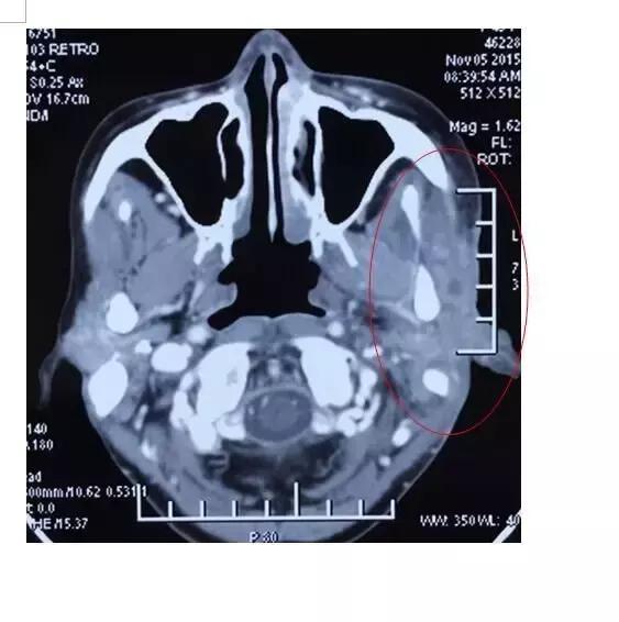 腮腺癌的治疗方案,腮腺癌用啥药治疗