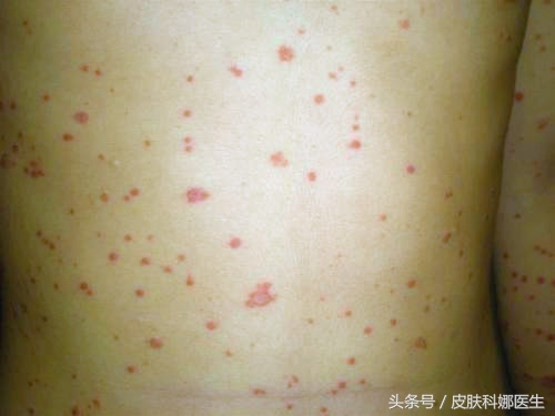 孩子发烧过后脸上起小丘疹,女童发烧身上起红疹是什么原因