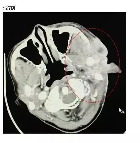 腮腺癌的治疗方案,腮腺癌用啥药治疗