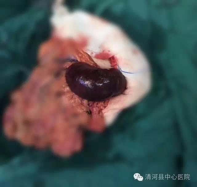 一个巨响的喷嚏过后，他被切下了小肠