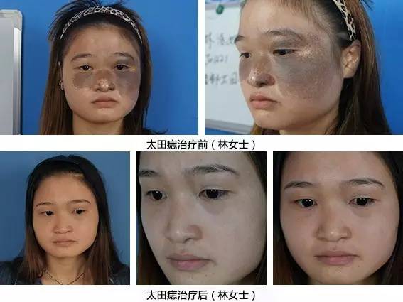 痣该不该祛,有痣需要去掉吗