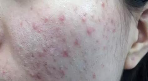 长痘痘怎么才能彻底治好,长痘痘怎么彻底治好