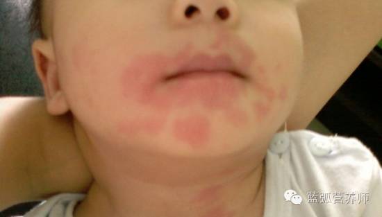 预防婴幼儿食物过敏的最好方法,宝宝食物过敏的处理方法