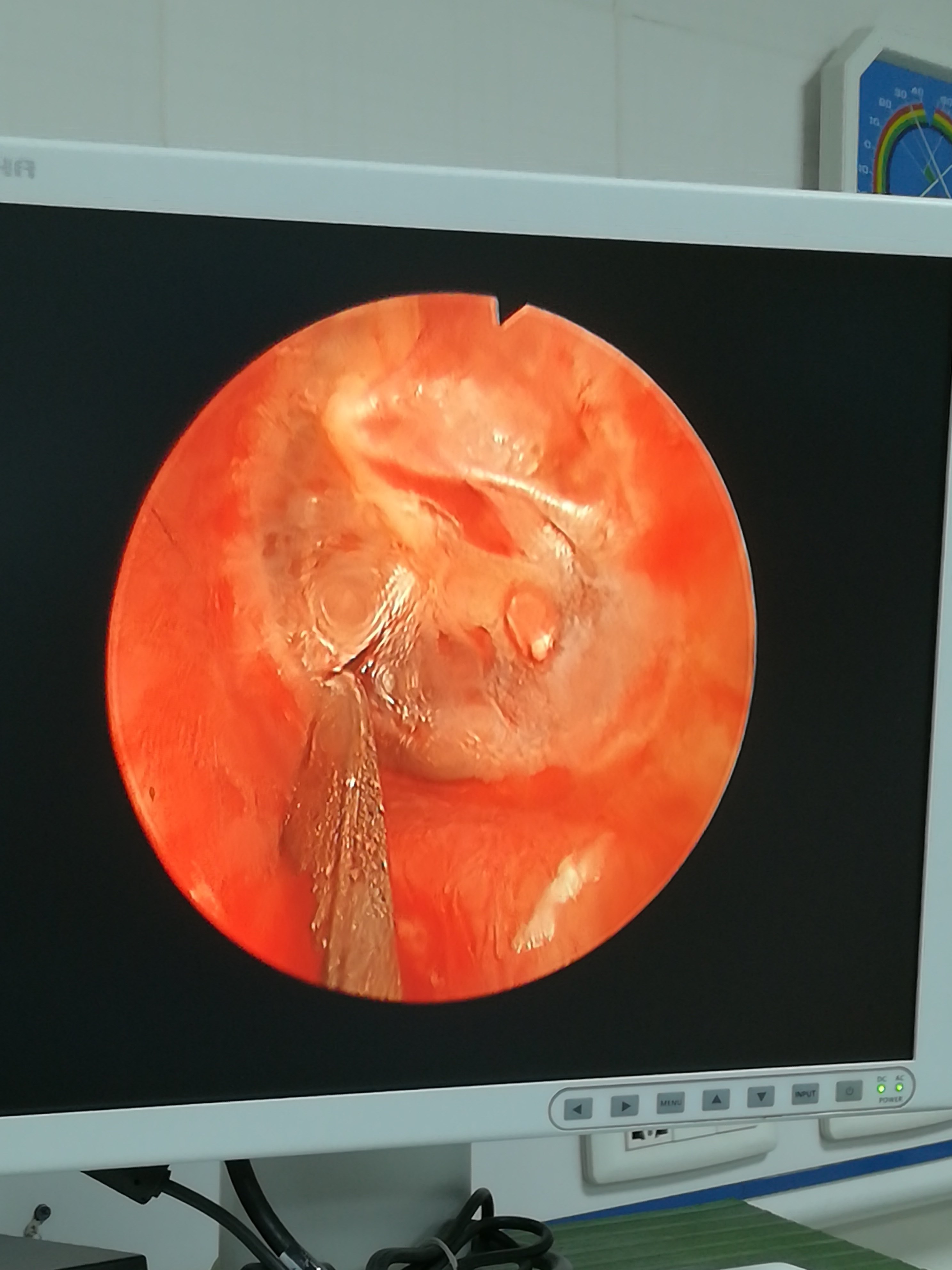 容易让爸妈忽略的小儿疾病中耳炎,怎么判断分泌物性中耳炎