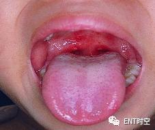 疱疹性咽峡炎是手足口病的前期吗,手足口病和疱疹性咽峡炎怎么分别