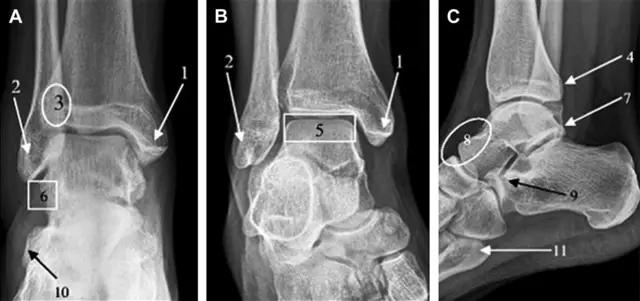 放射科夜班病例大全,放射科容易漏诊的骨折