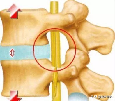 腰椎间盘突出跑步好还是跳绳好,腰椎间盘4-5节突出可以跑步吗