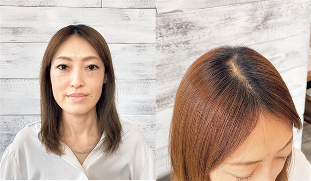 40岁女人头顶脱发严重怎么办,女人头顶有旋头发很少怎么处理