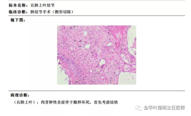 右上肺结节灶一般是什么癌,右上肺恶性肿瘤是肺癌吗