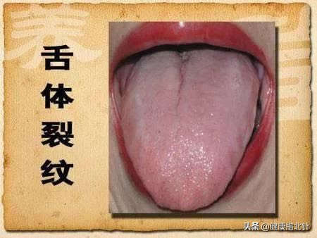 一招教你看舌苔6种舌苔你是哪种,身体好不好看嘴唇就知道了
