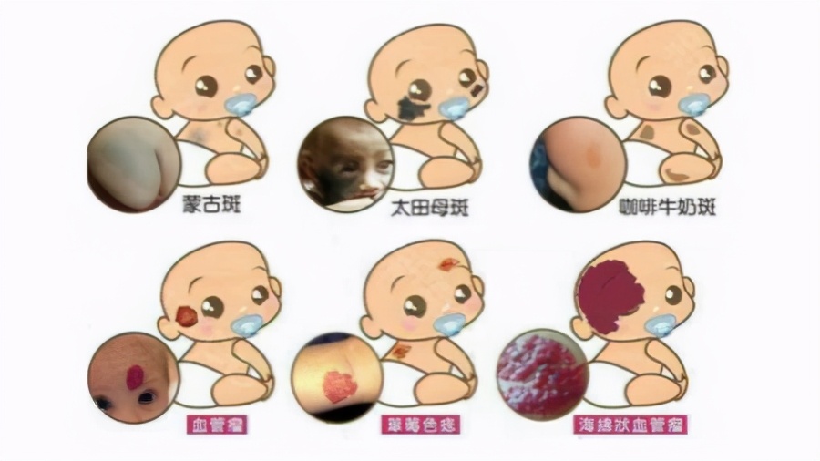 宝宝头上胎记,宝宝出生有青胎记