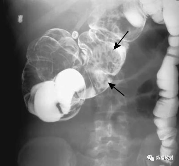 腹部影像图片大全,乙状直肠疼痛位置图片
